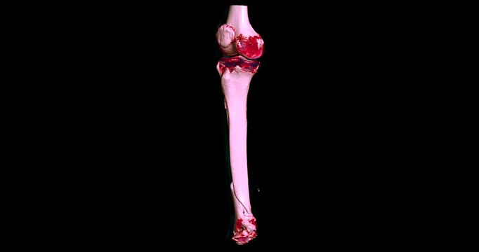 CT scan of leg and ankle showing a fracture in the tibia and fibula bones. Detailed medical imaging perfect for educational, diagnostic, and healthcare content.