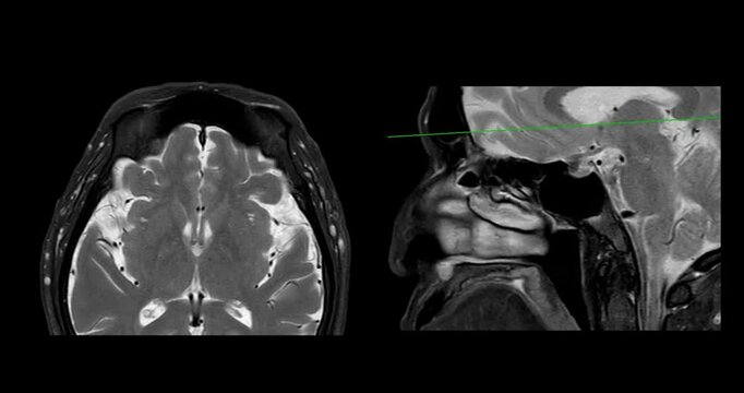 High-Resolution MRI Scan of Paranasal Sinuses for Medical Diagnosis and Anatomical Study.