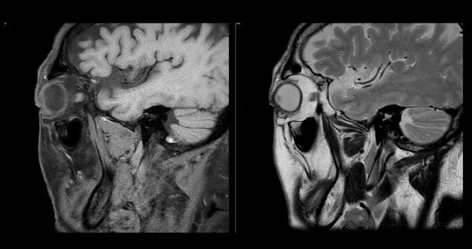 High-Resolution MRI Scan of Paranasal Sinuses for Medical Diagnosis and Anatomical Study.