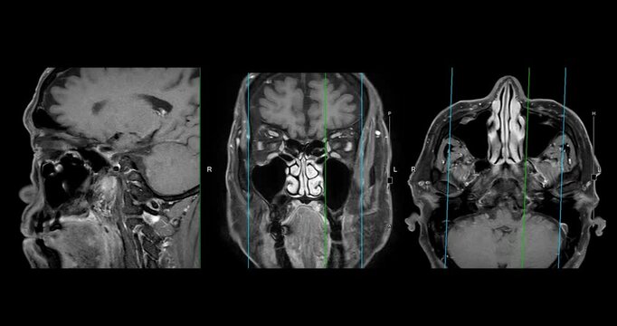 High-Resolution MRI Scan of Paranasal Sinuses for Medical Diagnosis and Anatomical Study.