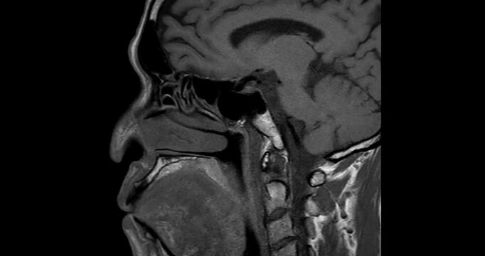 High-Resolution MRI Scan of Paranasal Sinuses for Medical Diagnosis and Anatomical Study.