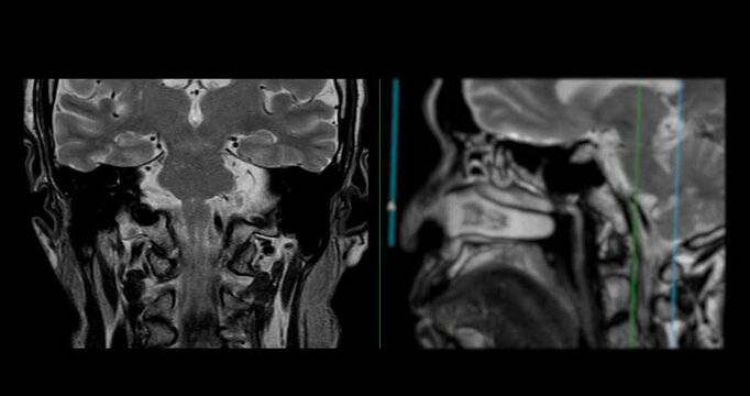 High-Resolution MRI Scan of Paranasal Sinuses for Medical Diagnosis and Anatomical Study.