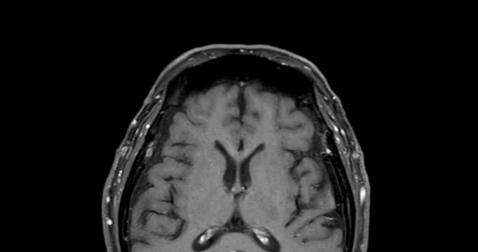 High-Resolution MRI Scan of Paranasal Sinuses for Medical Diagnosis and Anatomical Study.