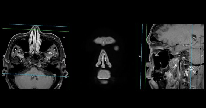 High-Resolution MRI Scan of Paranasal Sinuses for Medical Diagnosis and Anatomical Study.