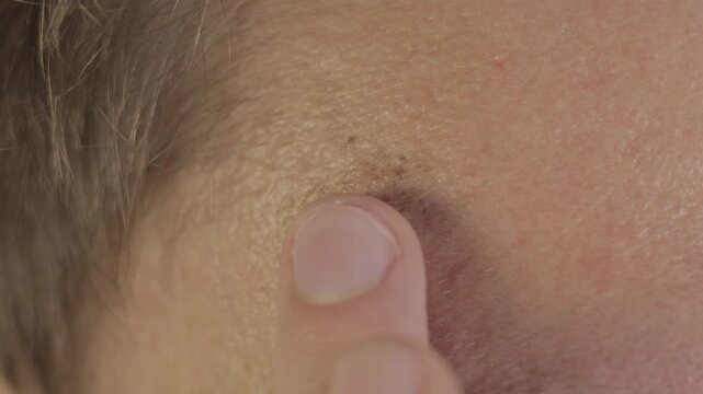 Pigmented spots on the forehead. Close-up. Spot melasma pigmentation facial treatment. Skin care.