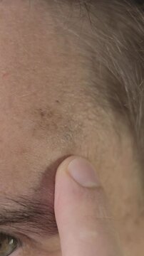 Vertical footage of a pigmented spots on the forehead. Close-up. Spot melasma pigmentation facial treatment. Skin care.