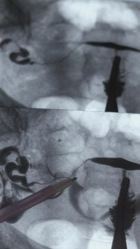 X-ray image of Hysterosalpingography (HSG). MRI with contrast agent. Patency of the uterus, ovaries and fallopian tubes. Uterine tubes, analysing female reproductive system. Infertility treatment.