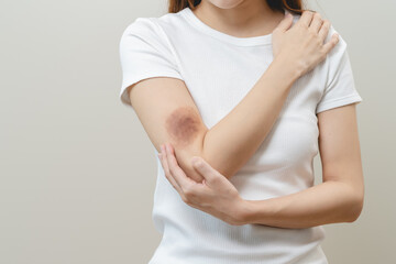 Close up of stain bruise wound on arm, contusion asian young woman, girl an accident fell down...