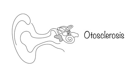 Otosclerosis