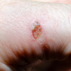 Human body wound. Skin irritation after shaving, pimples and acne and fungus.