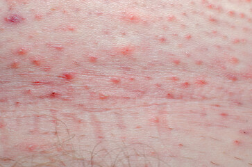 Human body wound. Skin irritation after shaving, pimples and acne and fungus.