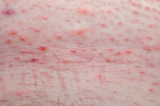 Human body wound. Skin irritation after shaving, pimples and acne and fungus.