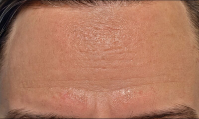 Fototapeta premium Allergic Rash On Forehead