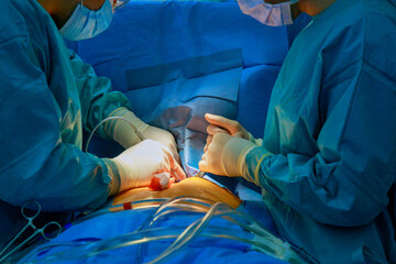 During open heart surgery at hospital, medical team of surgeons performs surgery on patient