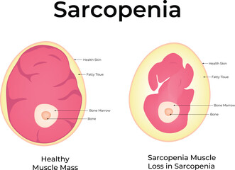 Sarcopenia Science Design Vector Illustration Diagram