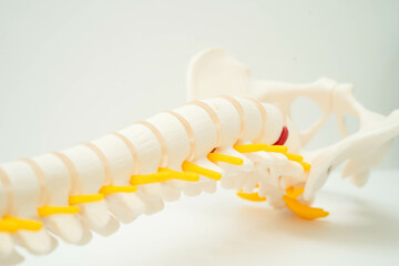 Spinal nerve and bone, Lumbar spine displaced herniated disc fragment, Model for treatment medical in the orthopedic department.