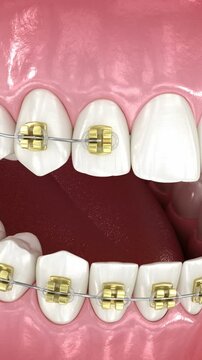 Dental braces placement, orthodontic treatment. Dental 3D animation
