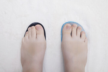 Presentation of incorrect footwear that deforms the foot. Small size of the insole, which causes pain in the foot and valgus. After an example of an anatomical insole