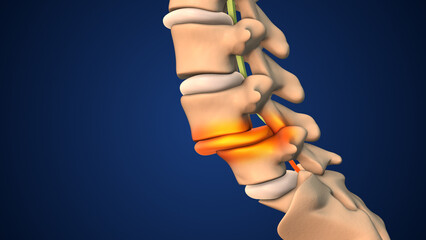 Spondylolisthesis Involving Vertebrae Shifting Out of Place