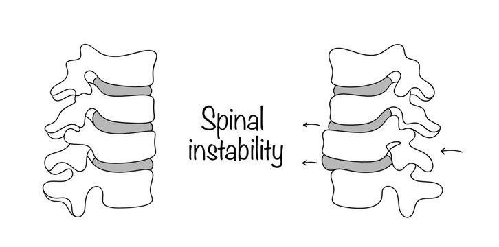 Spinal instability