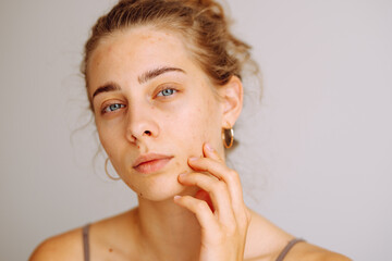 A young woman inspects her skin in natural light. Concept of acne therapy, scars, inflammation.