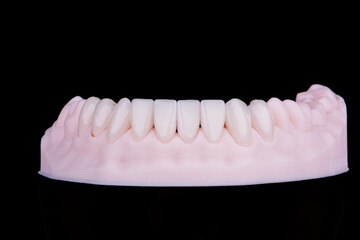 High-quality dental ceramic crowns for fixation to the frontal teeth of lower jaw.