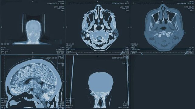 Magnetic resonance images of the brain, MRI of the brain, front and side view of a patient with multiple vascular infarctions, 3x3 image grid, color animation Seamless Loop
