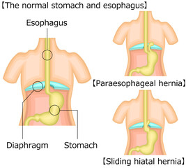食道　胃　裂孔ヘルニア　イラスト　英語