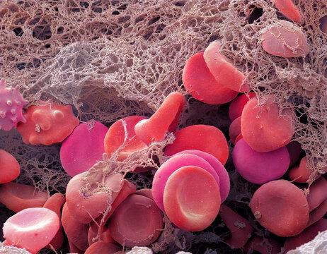 Blood clot, SEM