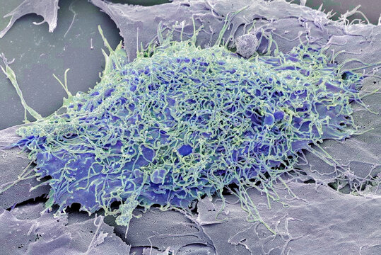 Bone cancer cell, SEM