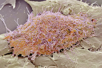 Bone cancer cell, SEM