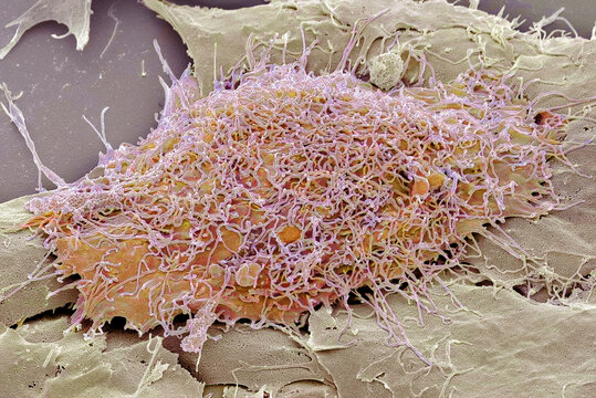Bone cancer cell, SEM