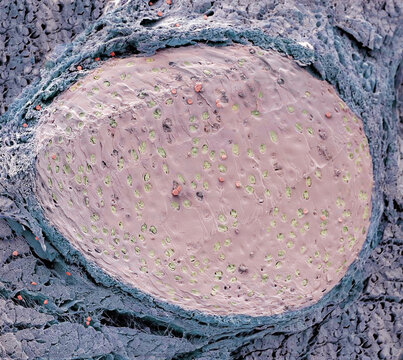 Rib fracture, SEM