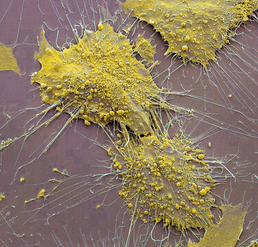 Bone cancer cells, SEM