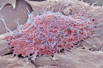 Bone cancer cell, SEM