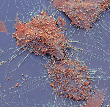 Bone cancer cells, SEM