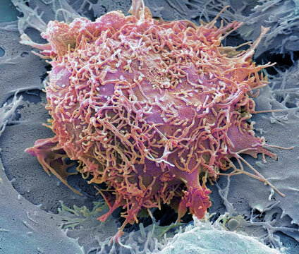 Liver cancer, SEM