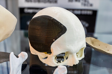 Orthopedic implants and individual titanium cranioplasties printed on a 3D printer.