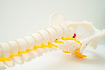 Spinal nerve and bone, Lumbar spine displaced herniated disc fragment, Model for treatment medical in the orthopedic department.