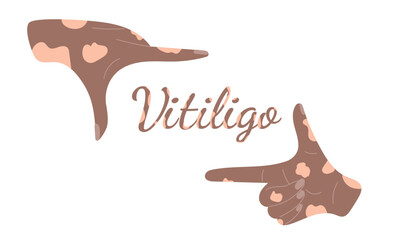 Two hands with vitiligo disease made a frame for text on white background. World vitiligo day awareness. Hand drawn vector illustration in flat style. Skin disease, diversity concept