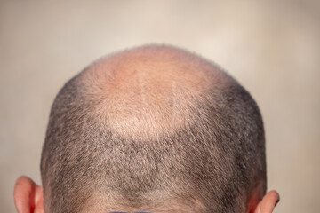 Obraz premium Bald head man, back of head, baldness, hair transplant, hair loss. Hair loss close-up.