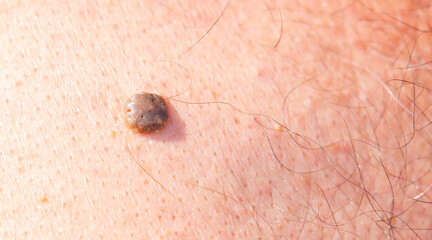Nevus close-up. Mole on human skin. Irregular birthmark.