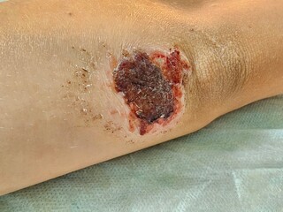 Wound healing process on the forearm showing inflammation and scabbing