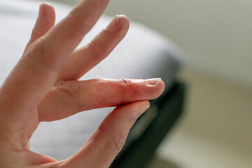 Mallet finger healing after splint removal from middle finger following joint trauma