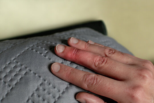 Mallet finger healing after splint removal from middle finger following joint trauma