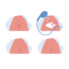 4 steps of shaving routine. Real female body with stretch marks. Set of woman shaves her pubic hair with razor. Flat vector illustration in flat style.