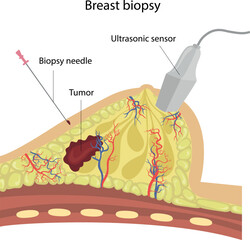 Diagnosis of breast disease