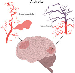 . Hemorrhagic stroke and ischemic stroke of the brain.