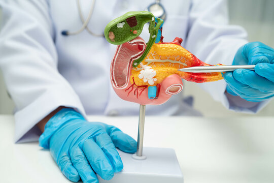 Pancreatitis, pancreatic cancer, Asian doctor with pancreas, gallbladder and bile duct human anatomy model at hospital.