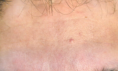 Fototapeta premium Close-up view of human skin showing texture, pores, and minor blemishes, highlighting the natural imperfections of skin.